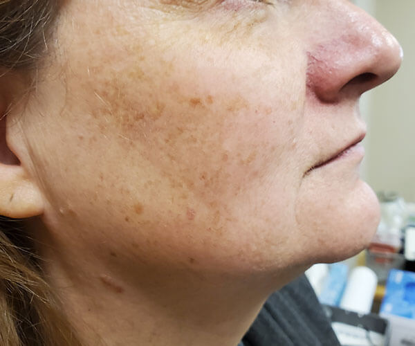 Skin Pigmentation After Skin Pigmentation After
