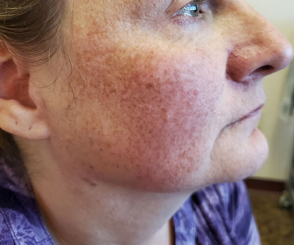 Skin Pigmentation Before Skin Pigmentation Before