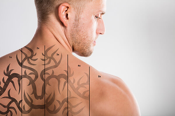 Tattoo Removal at Electrolysis and Laser Center